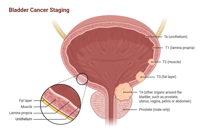 Bladder Cancer Staging 4405